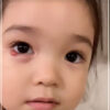 紅蘭の娘の目の画像が可哀想？霰粒腫の病気や治療についても調査！