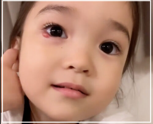 紅蘭の娘の目の画像が可哀想？霰粒腫の病気や治療についても調査！